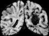 Arteriovenous malformation, with draining vein (superior)